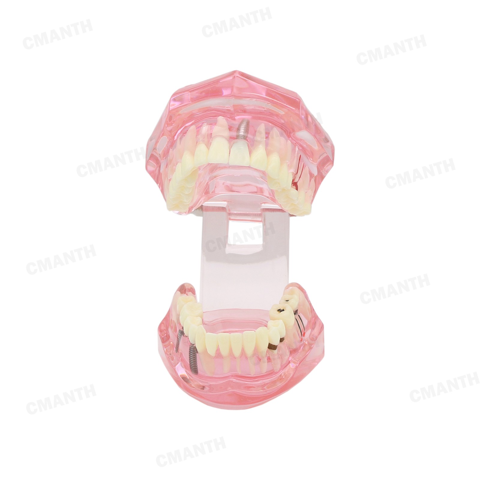 US Dental Teeth Implant Restoration Model Transparent Pathological Study Demo