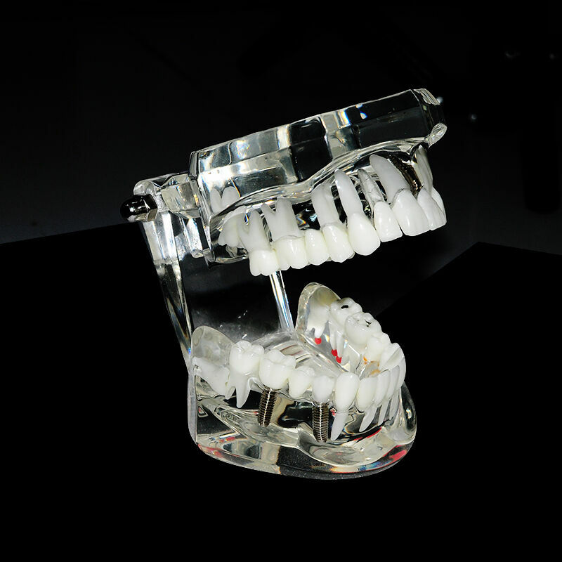 Dental Implant and Restoration Model Transparent Pathological Teeth Study Model