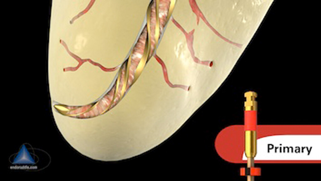WaveOne Gold Primary 21mm Endodontic Root Canal 3 Files. READ