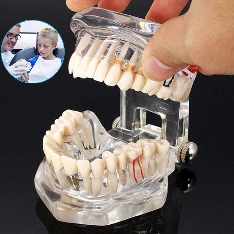 Dental Fake Teeth Study Model Implant Disease Education Denture Teach Analy