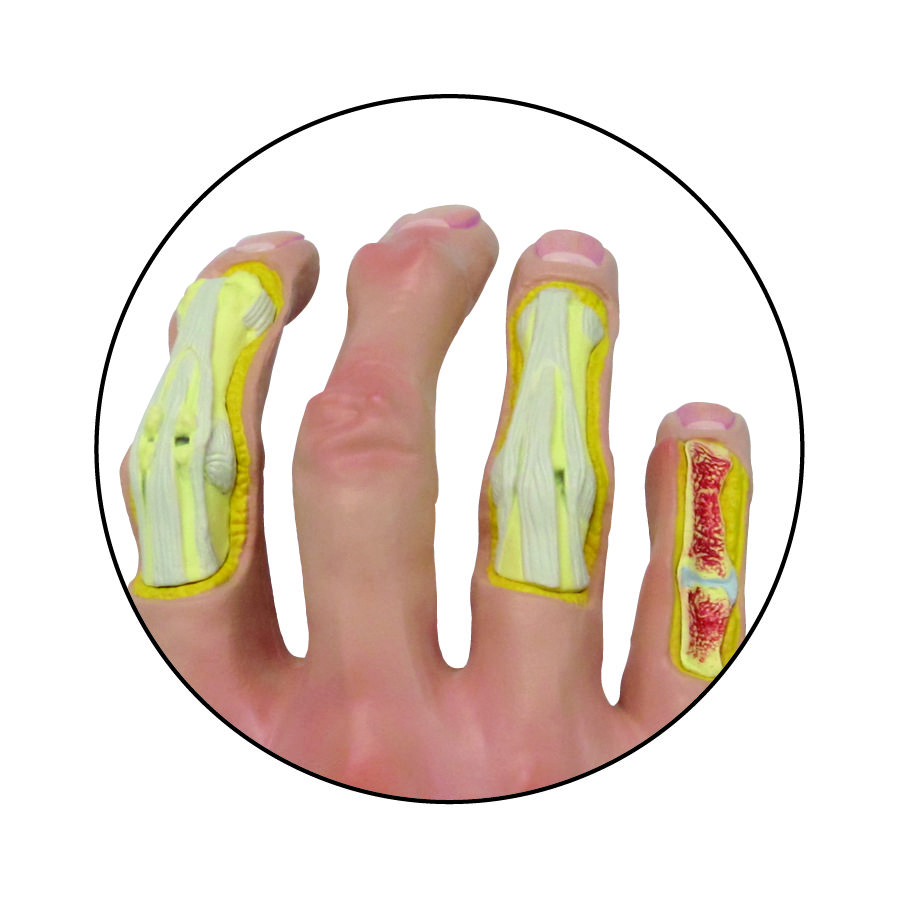 Hand Osteoarthritis (OA) GPI Anatomical Model LFA # 1930.Make Us An Offer! VIDEO