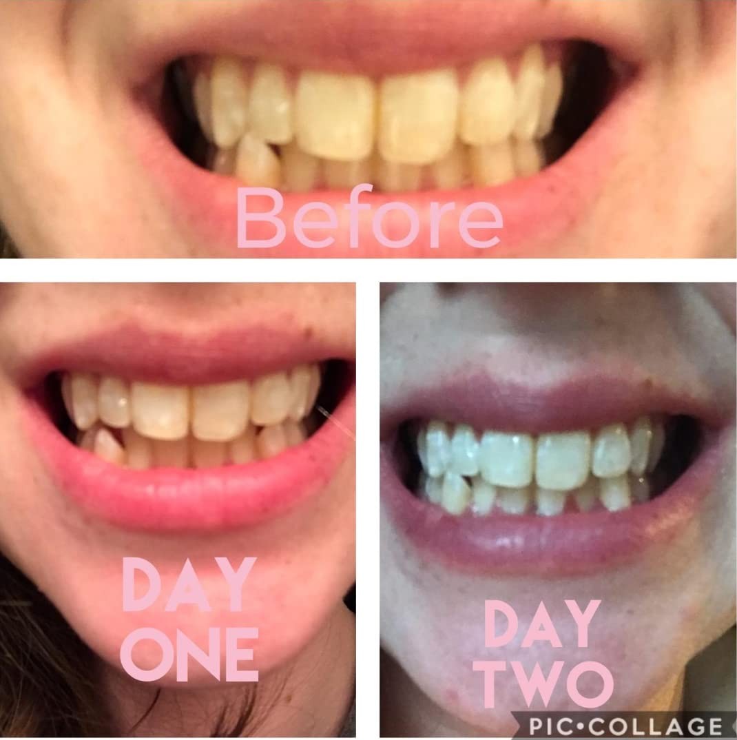 Smile Titan Teeth Whitening Gel Refill 4X Syringes 44% 0.1 Fl Oz (Pack of 4)