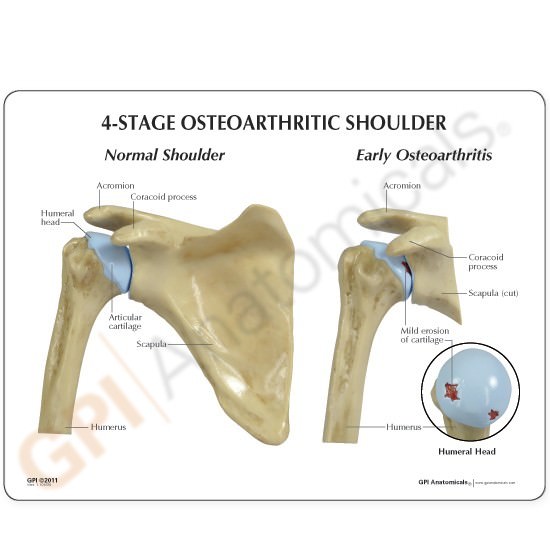 Shoulder Osteoarthritic 4-Stage GPI Anat Model Set LFA#1800 Make OfferSEE VIDEO