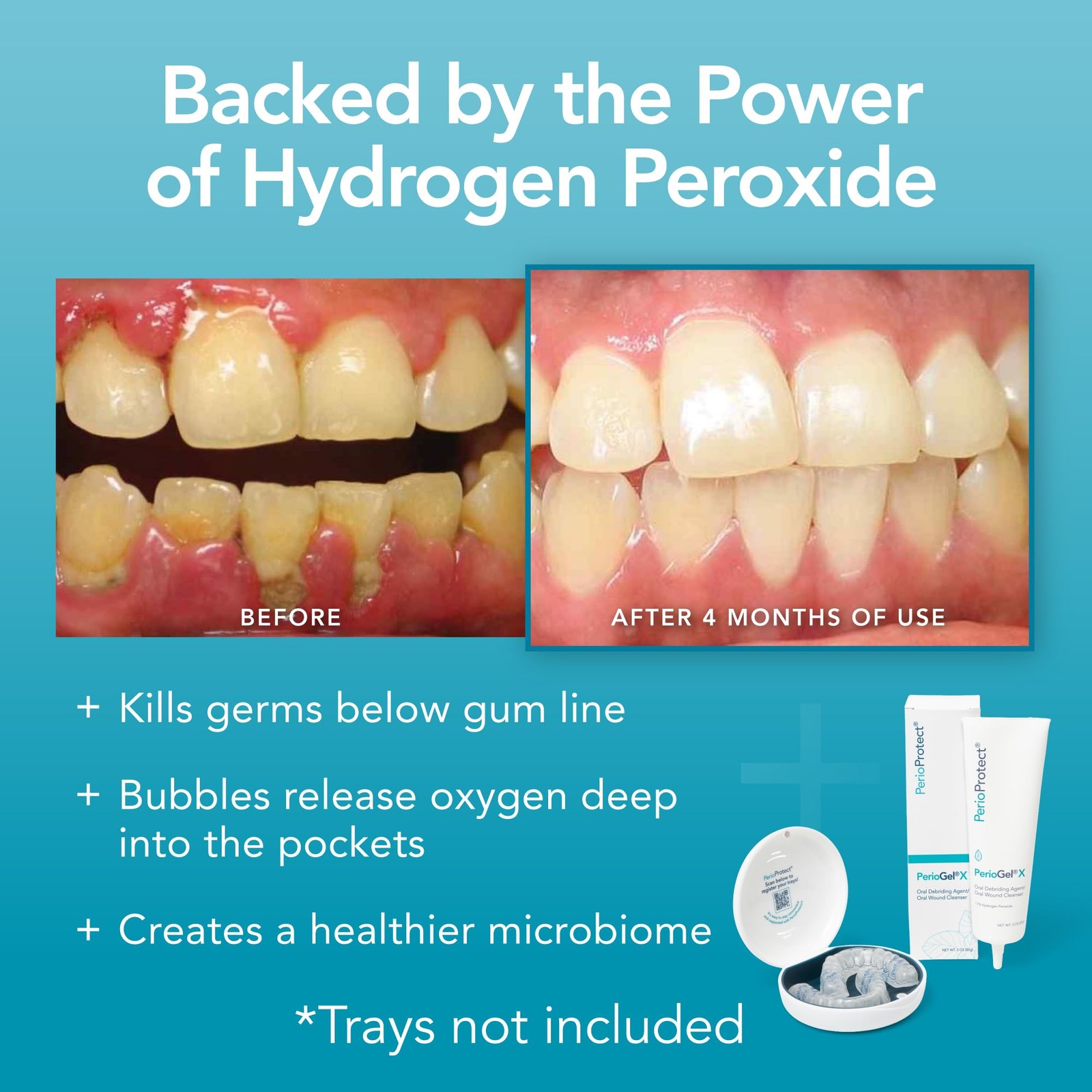 PerioGelX | Periodontal Treatment for Teeth | 3 Ounce (Pack of 1), White