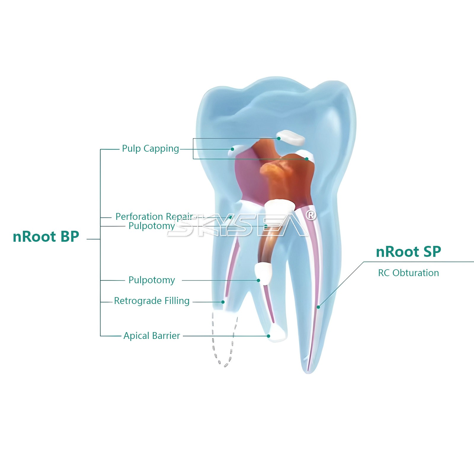 1g Material de Sellado para Endodoncia Injectable Biocerámico dentist