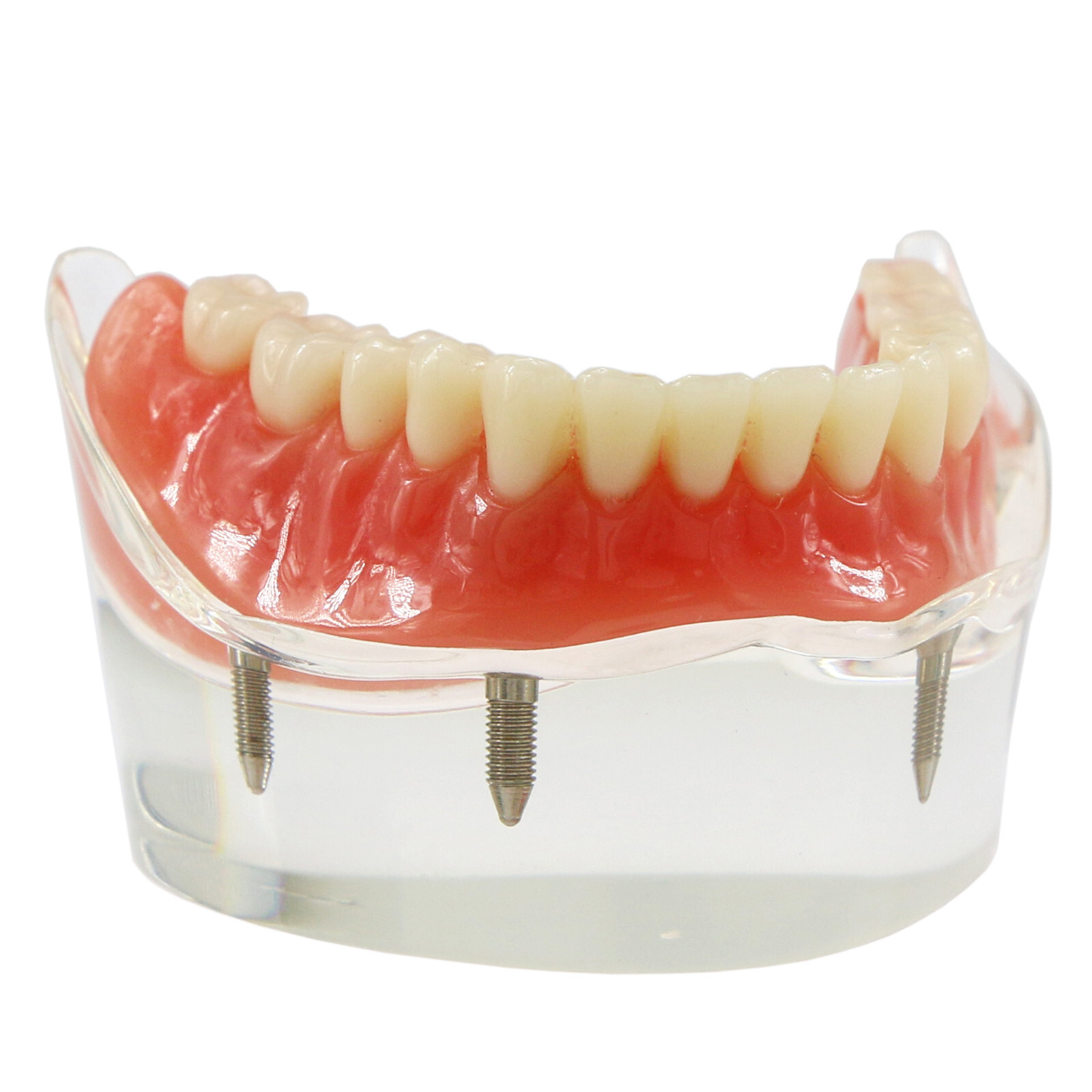 Implant Typodont Teeth Restoration Model Overdenture Practice Demo Series Dental
