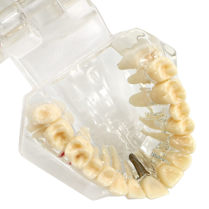 Dental Implant and Restoration Model Transparent Pathological Teeth Study Model