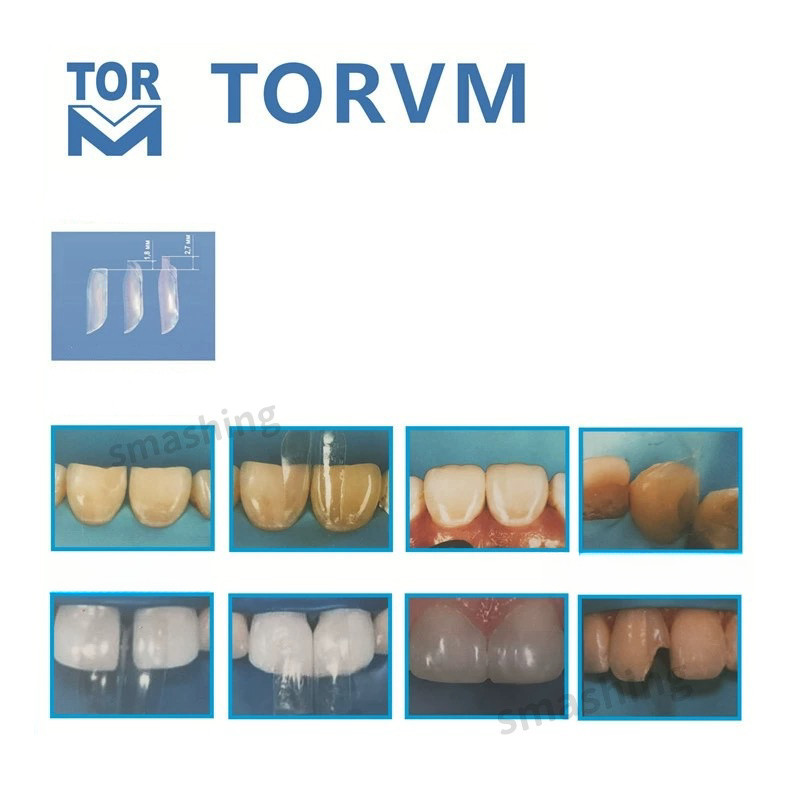 Dental Clear Matrix Anterior Matrices Bow BT Fits Bioclear Mixed Sizes 1.901