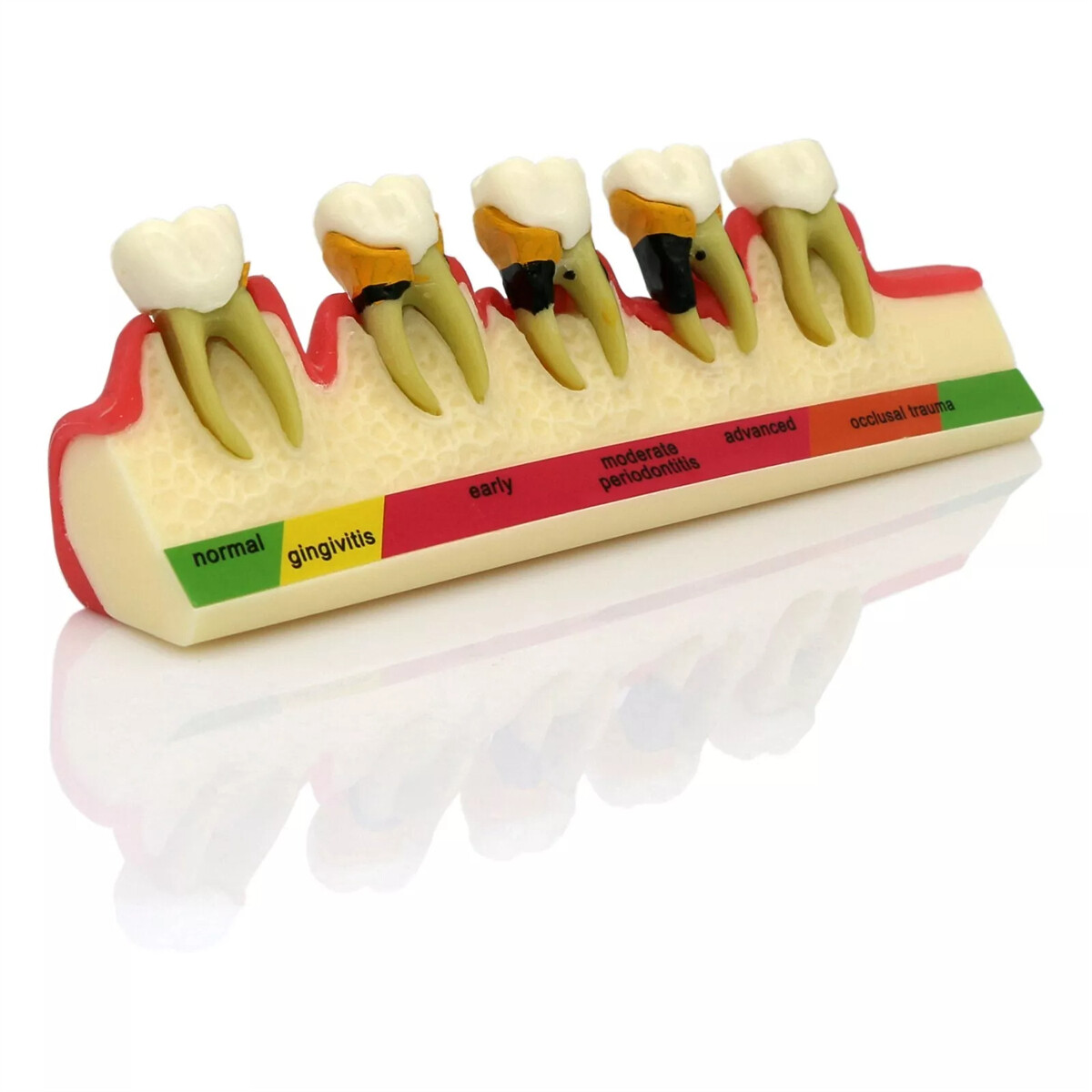 Dental Pathological Typodont Teeth Model Periodontics/Implant/Endodontic Caries