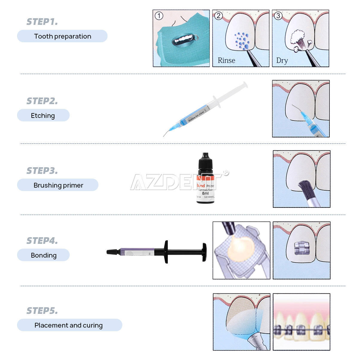 Dental Orthodontic Light Cure Bracket Braces Glue Bonding Resin/Etching Gel