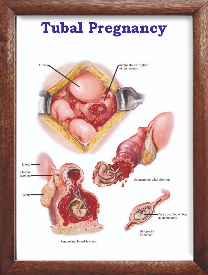 Tubal Pregnancy Chart 12×18 inches