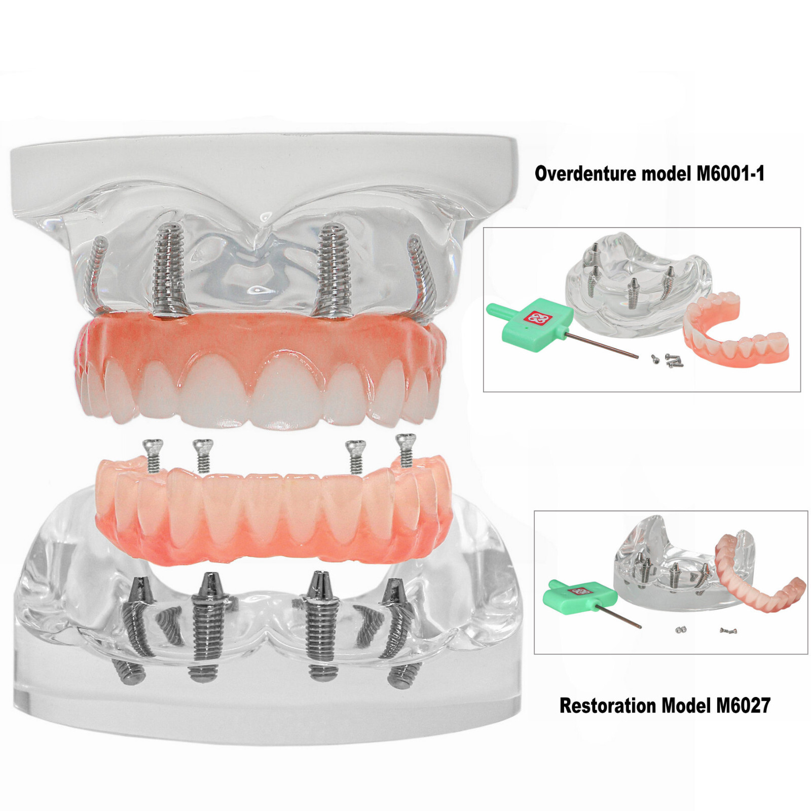 Dental 4 Implants Upper&Lower Demo Implant Teeth Model Restoration Overdenture