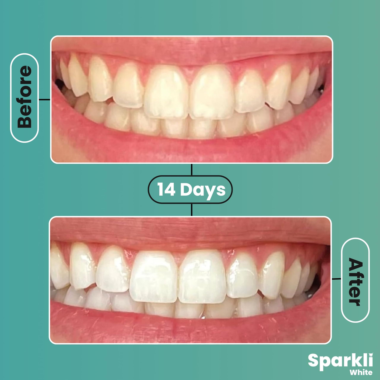 SparkliWhite Teeth Whitening Strips-Dentist 1 Count (Pack of 1), Mint