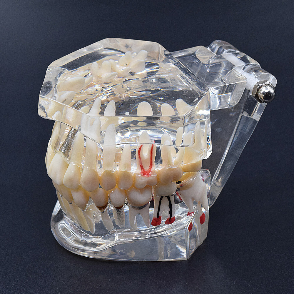 Dental Fake Teeth Study Model Implant Disease Education Denture Teach Analy