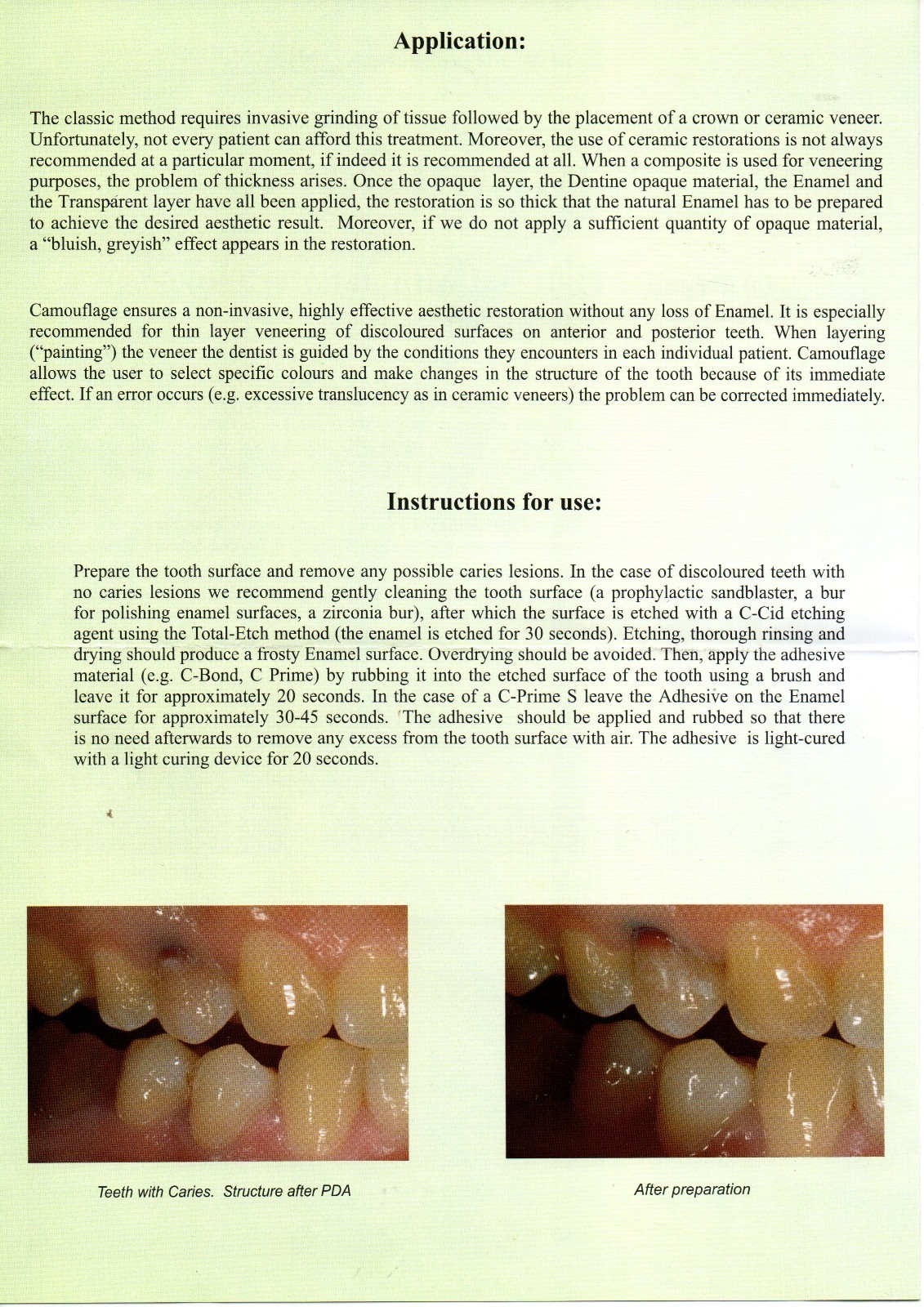 Dental Camouflage Flow Nano composite for direct laminate veneers Germany