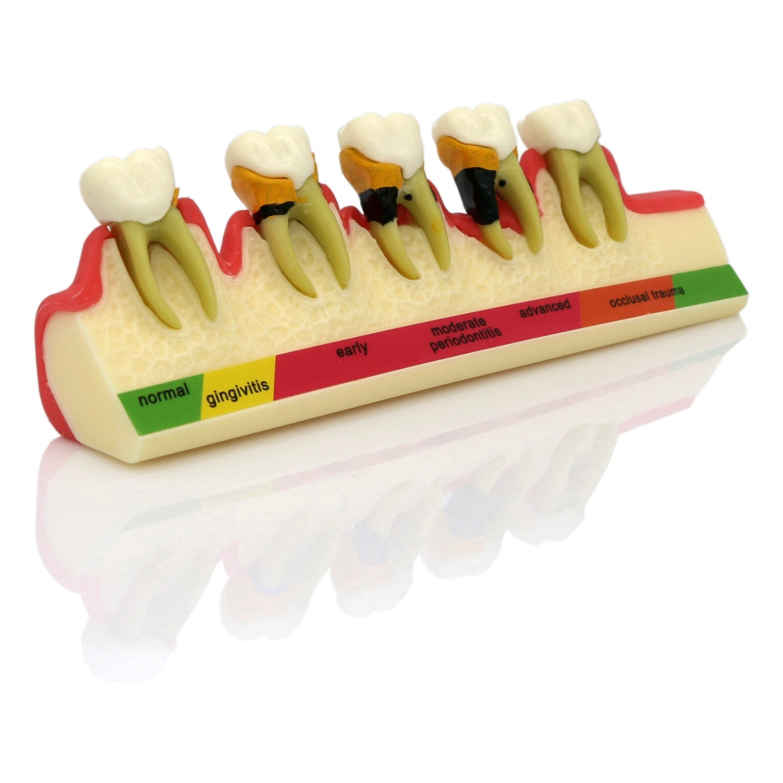 Dental Periodontics Disease 5-Stage Teeth Model Perio Disease Assort Demo Model