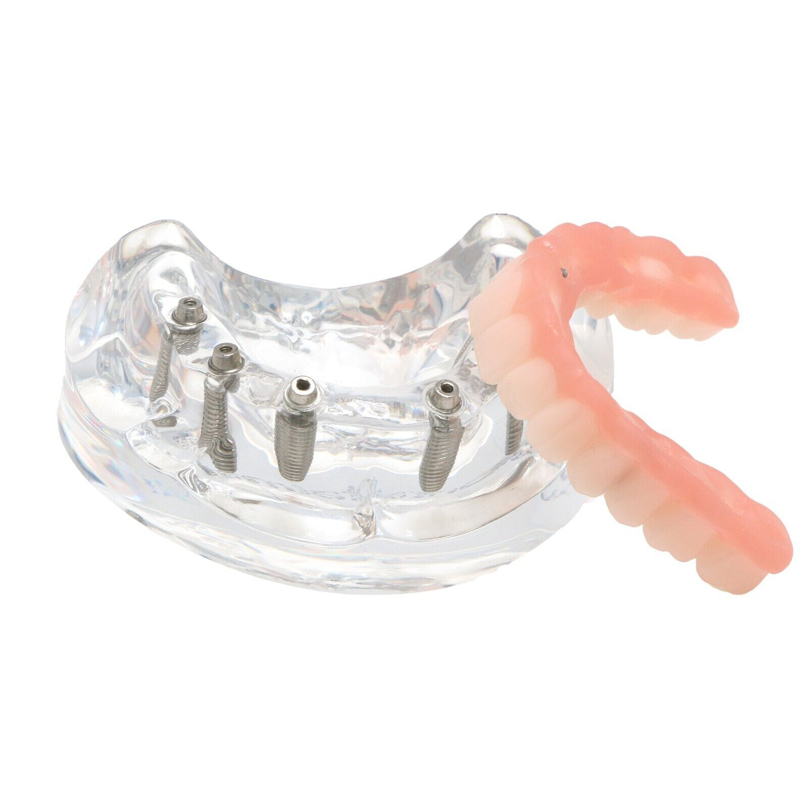 US Dental All-on-4/6 Screws Overdenture Implant Model Upper Jaw Restoration