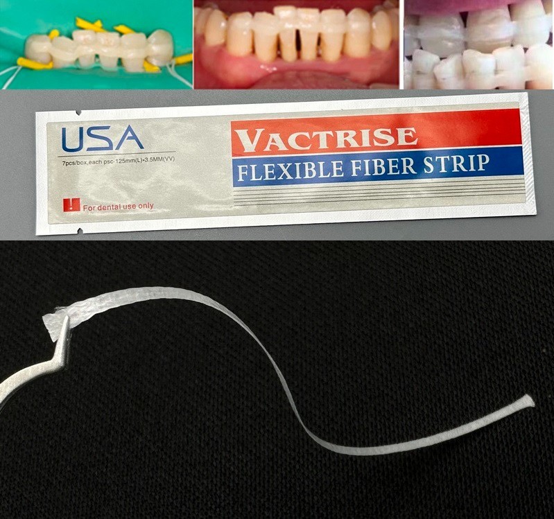 1pcs Dental Glass Fiber Splint Ribbond Ribbon Type Composite Resin Bonding Strip