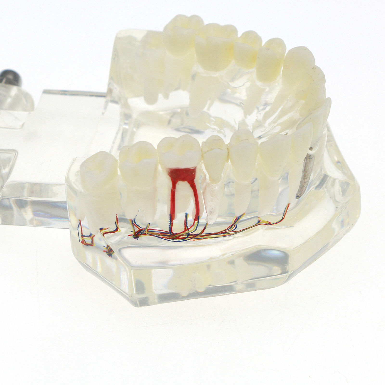 Dental Oral Typodont Model Implant Pathological Removable Teach Visible Anatomy
