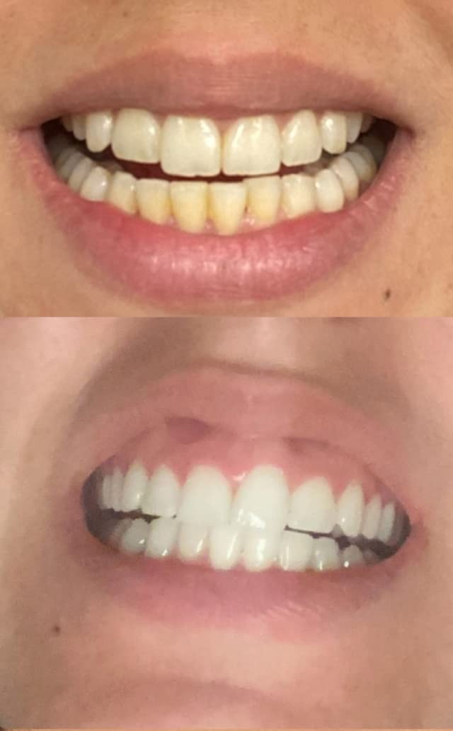 Smile Titan Teeth Whitening Gel Refill 4X Syringes 44% 0.1 Fl Oz (Pack of 4)