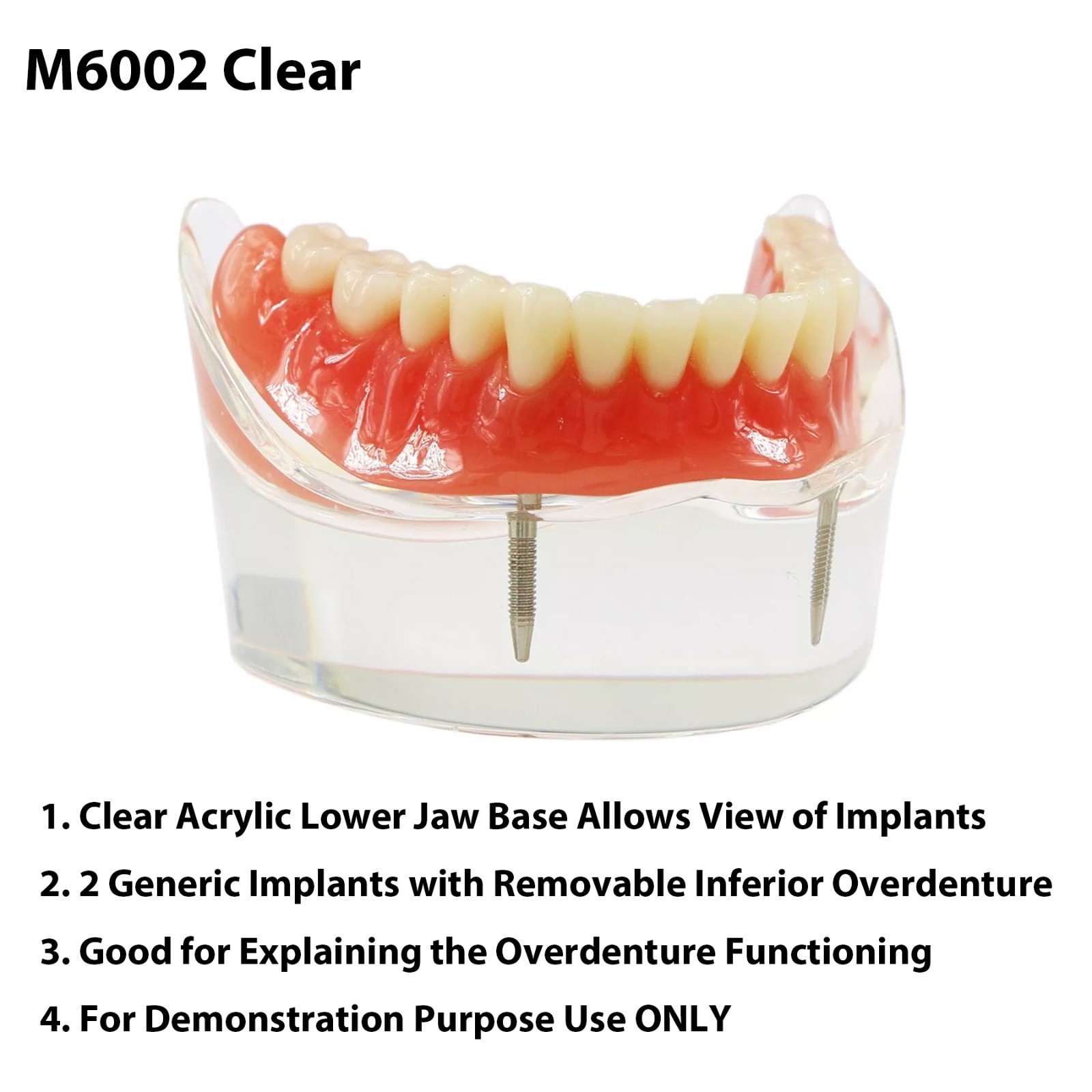 Dental Implant Overdenture Model Upper Lower Jaw Teeth Model with 2/4/6 Screws