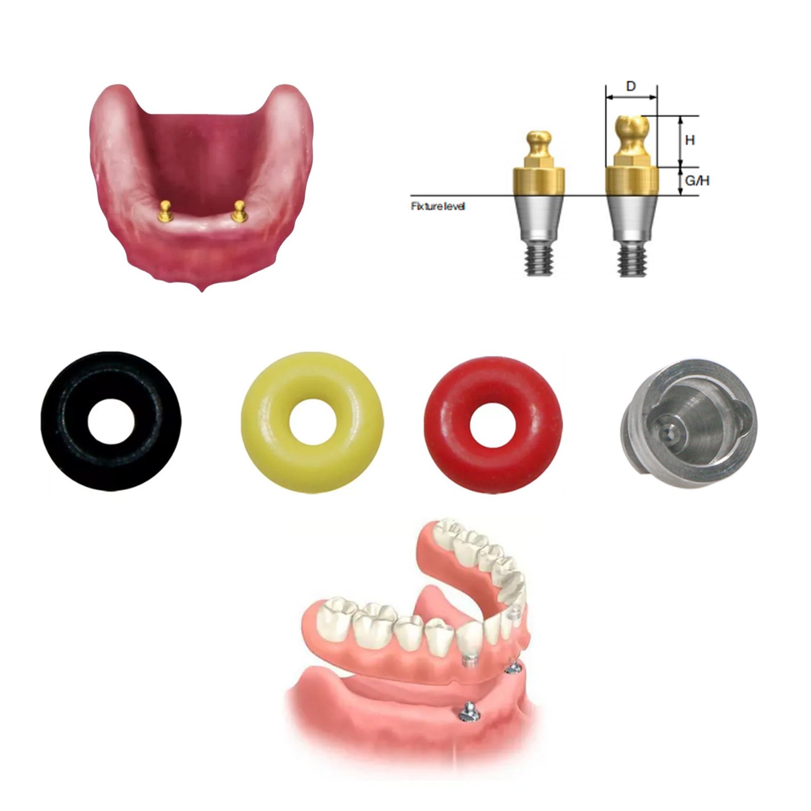 4Pc/Set Implant O-Ring Retention Cap Kit for Hiossen Osstem Ball Abutment Dental