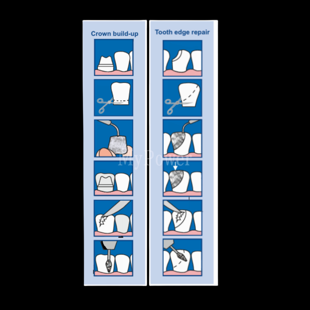 Dental Anterior Transparent Forms For Temporary Crowns 1.910 Kit TOR VM 64Pcs