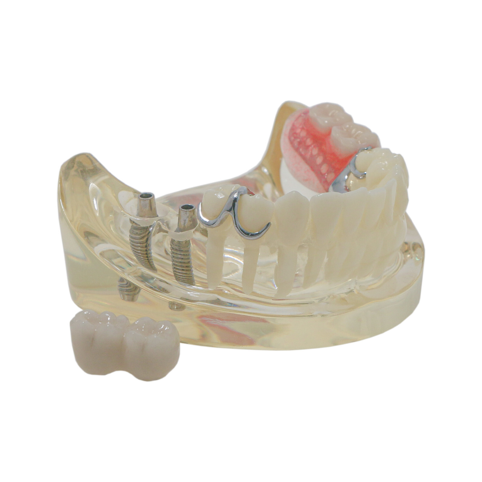 Dental Restoration Implant Typodont Teeth Model with Partial Denture M6022