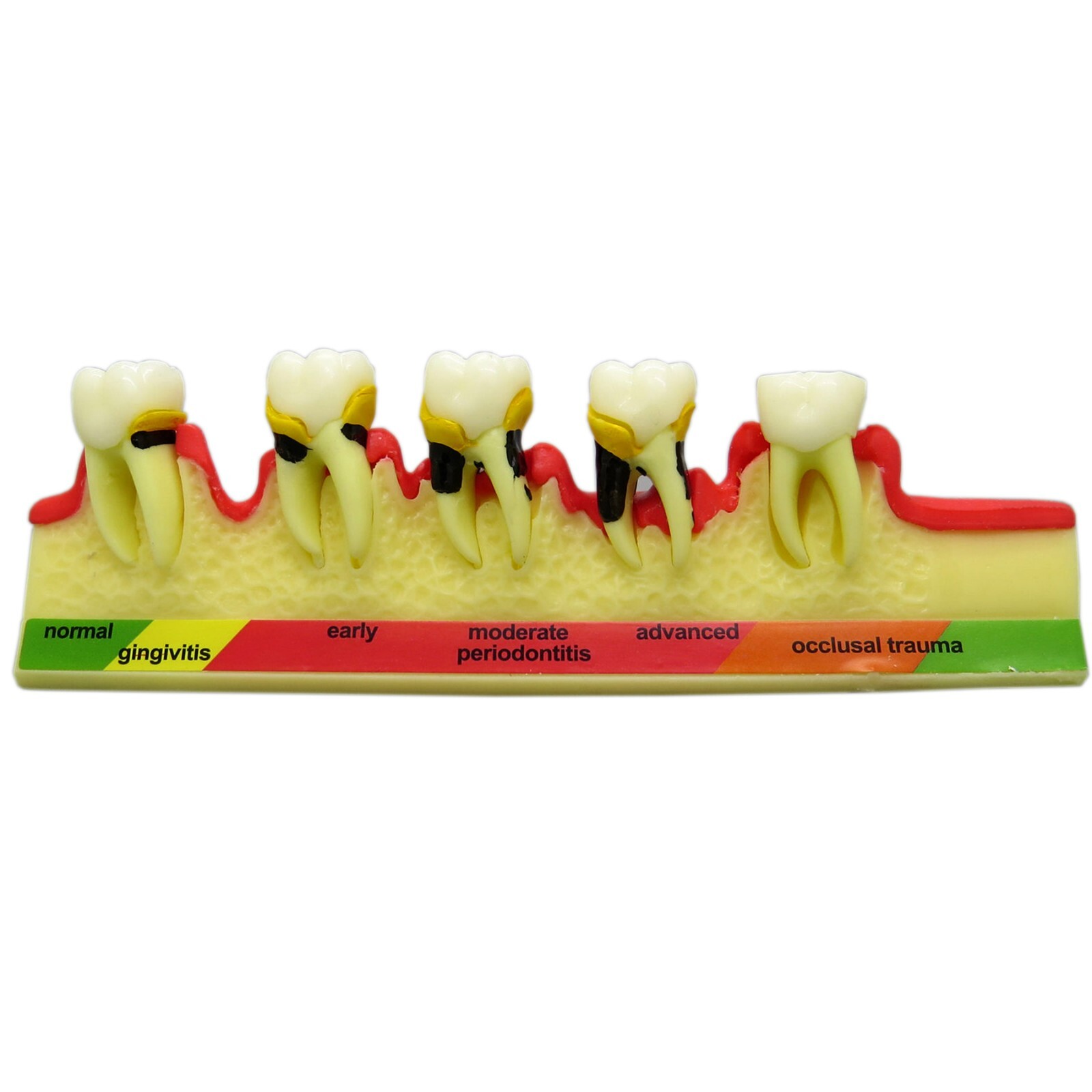 Dental Periodontics Disease 5-Stage Teeth Model Perio Disease Assort Demo Model
