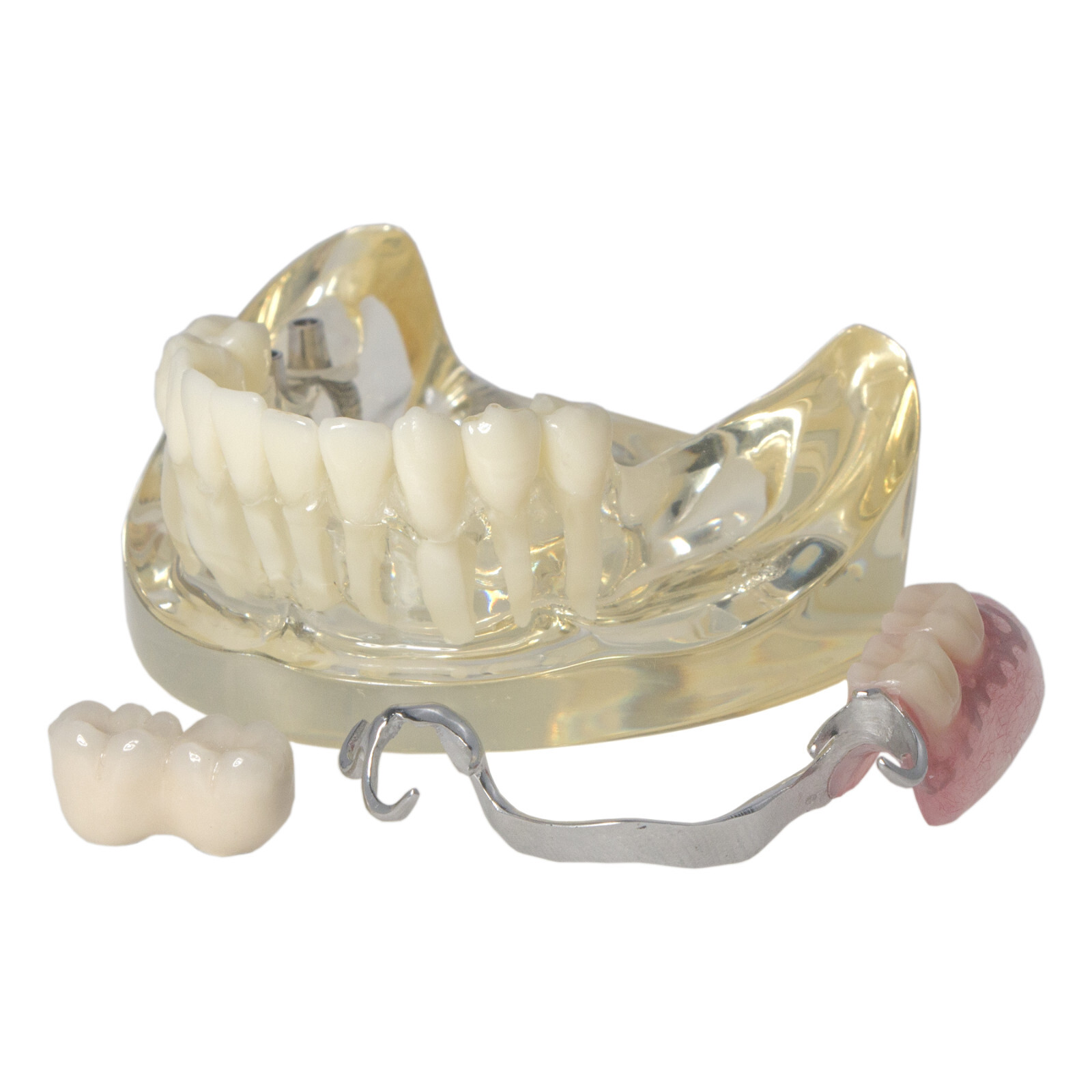 Dental Restoration Implant Typodont Teeth Model with Partial Denture M6022
