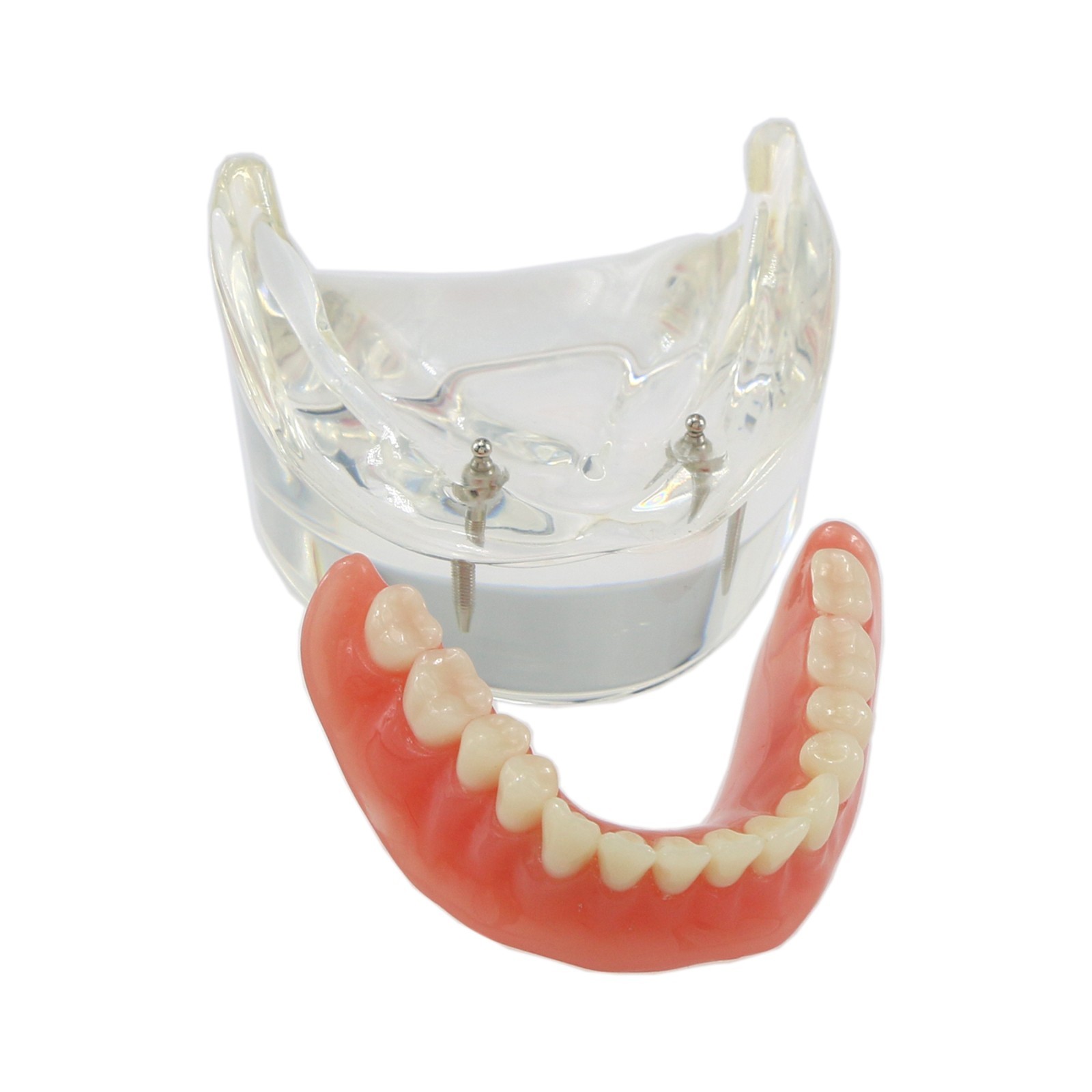 Dental Implant Overdenture Model Upper Lower Jaw Teeth Model with 2/4/6 Screws