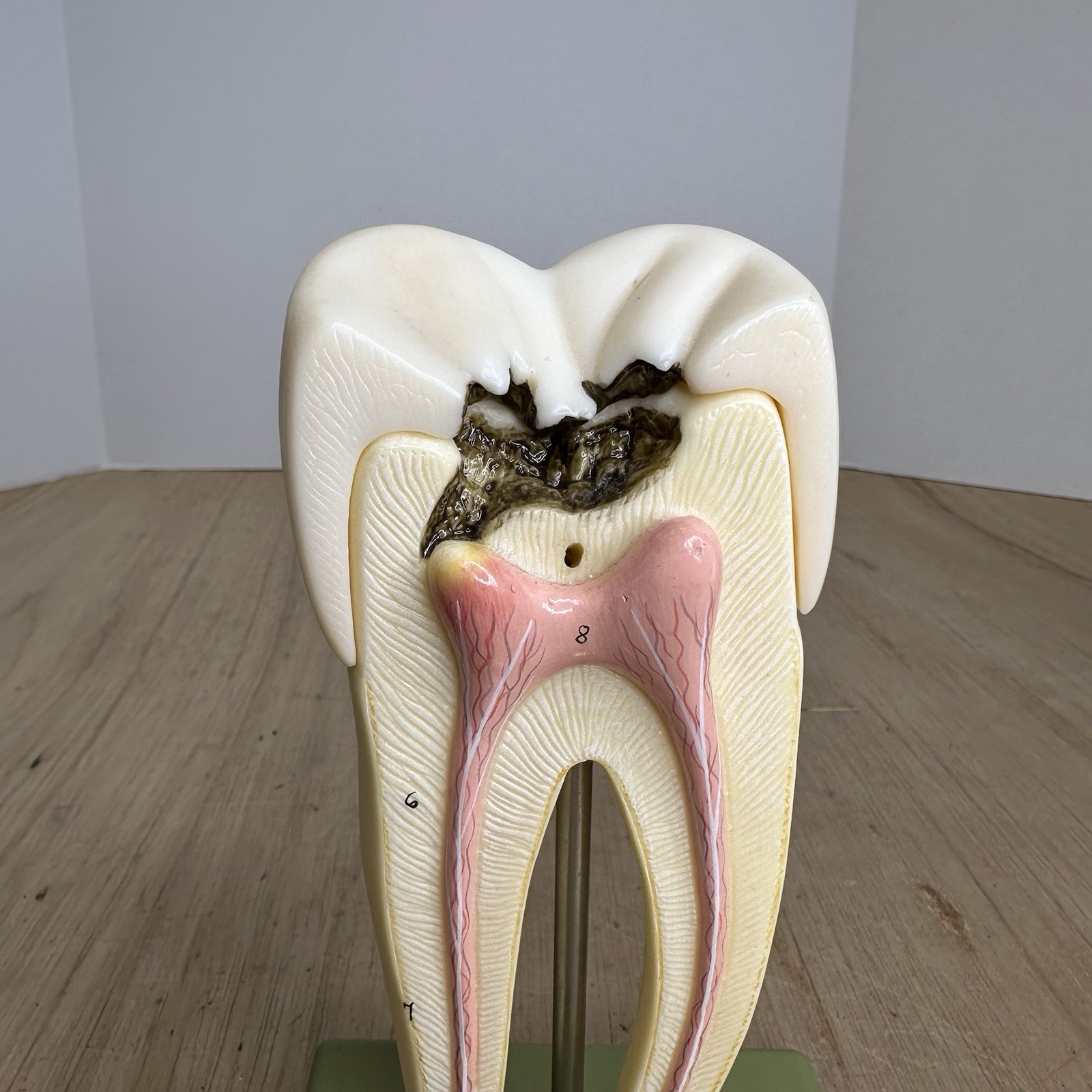 VTG SOSMO TOOTH ANATOMICAL MODEL DISPLAY DENTAL DENTISTRY EDUCTATIONAL GERMANY