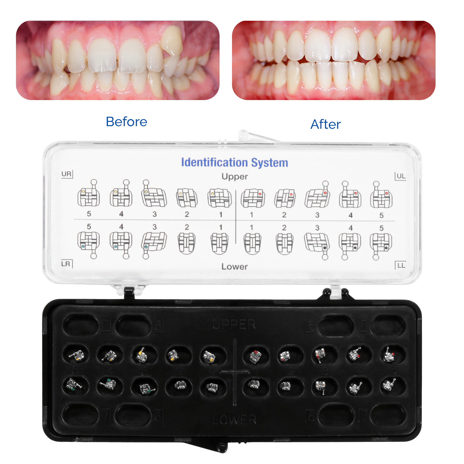 JMU Dental Orthodontic Metal Brackets Braces Standard Roth/MBT 018/022 Hooks 345