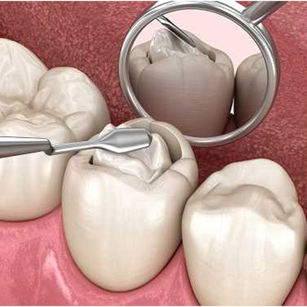Prime Dental Bulkfil (Packable) Free Shipping