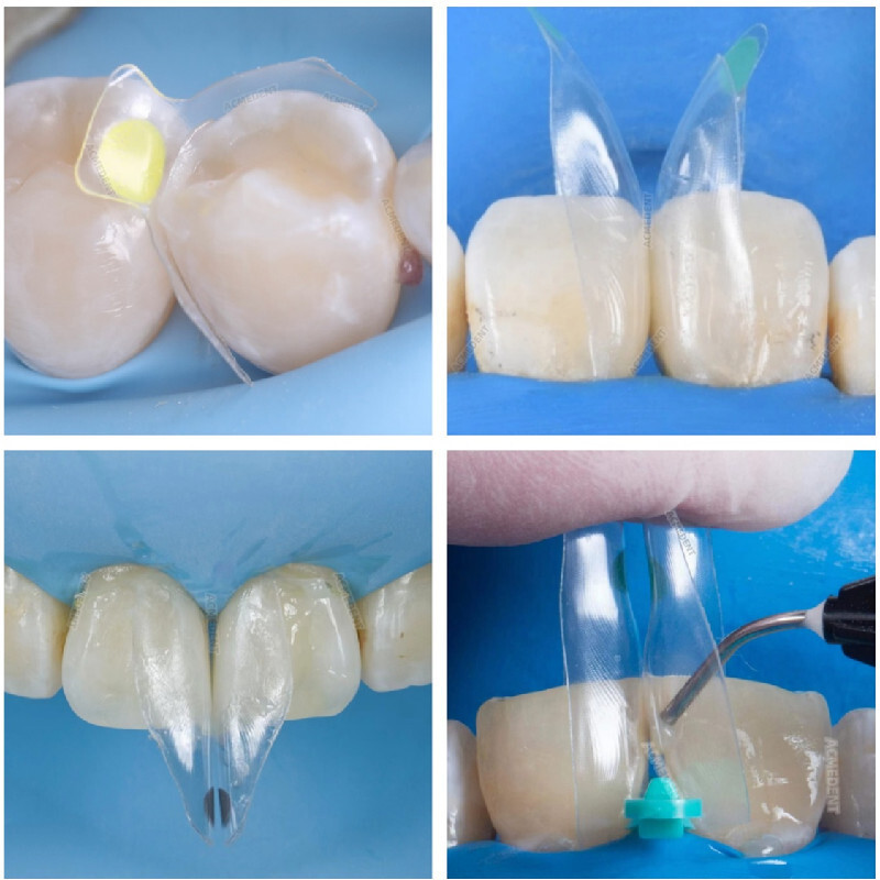 Clear Matrix Band Transparent Bow Matrices Dental Anterior Front Teeth Posterior