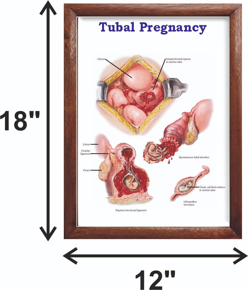 Tubal Pregnancy Chart 12×18 inches