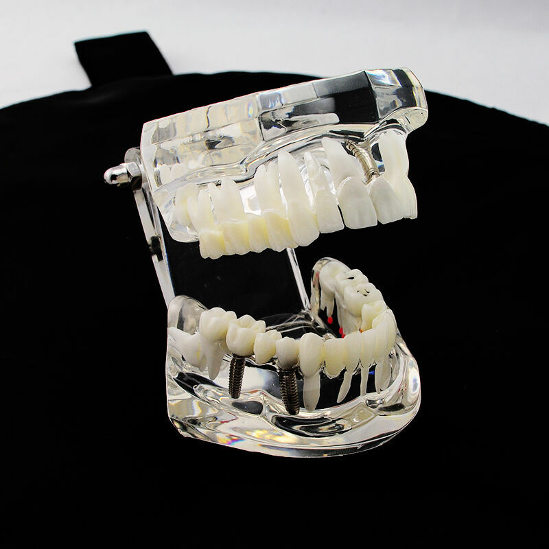 Dental Implant and Restoration Model Transparent Pathological Teeth Study Model
