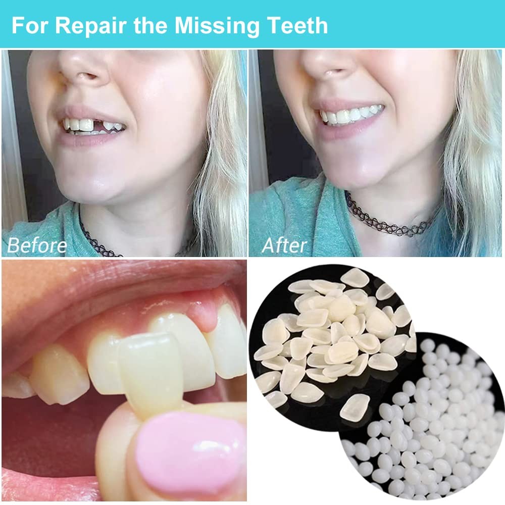 Brige Tooth Repair kit for Filling The Missing Broken 1 Count (Pack of 1)