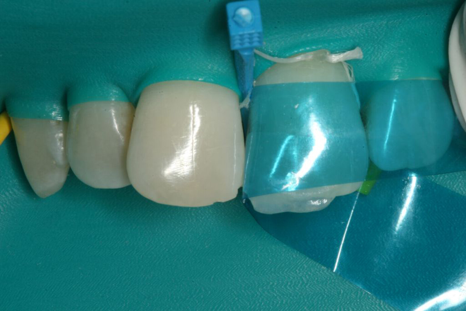 Dental Blue view varistrip Contoured Anterior Matrix Bands Restoration Matrices