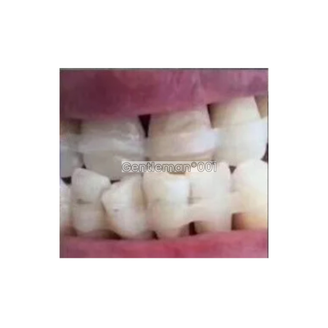 Dental Flexible Fiber Strip Band Retainer Glass Splint Loose Tooth Light Cure