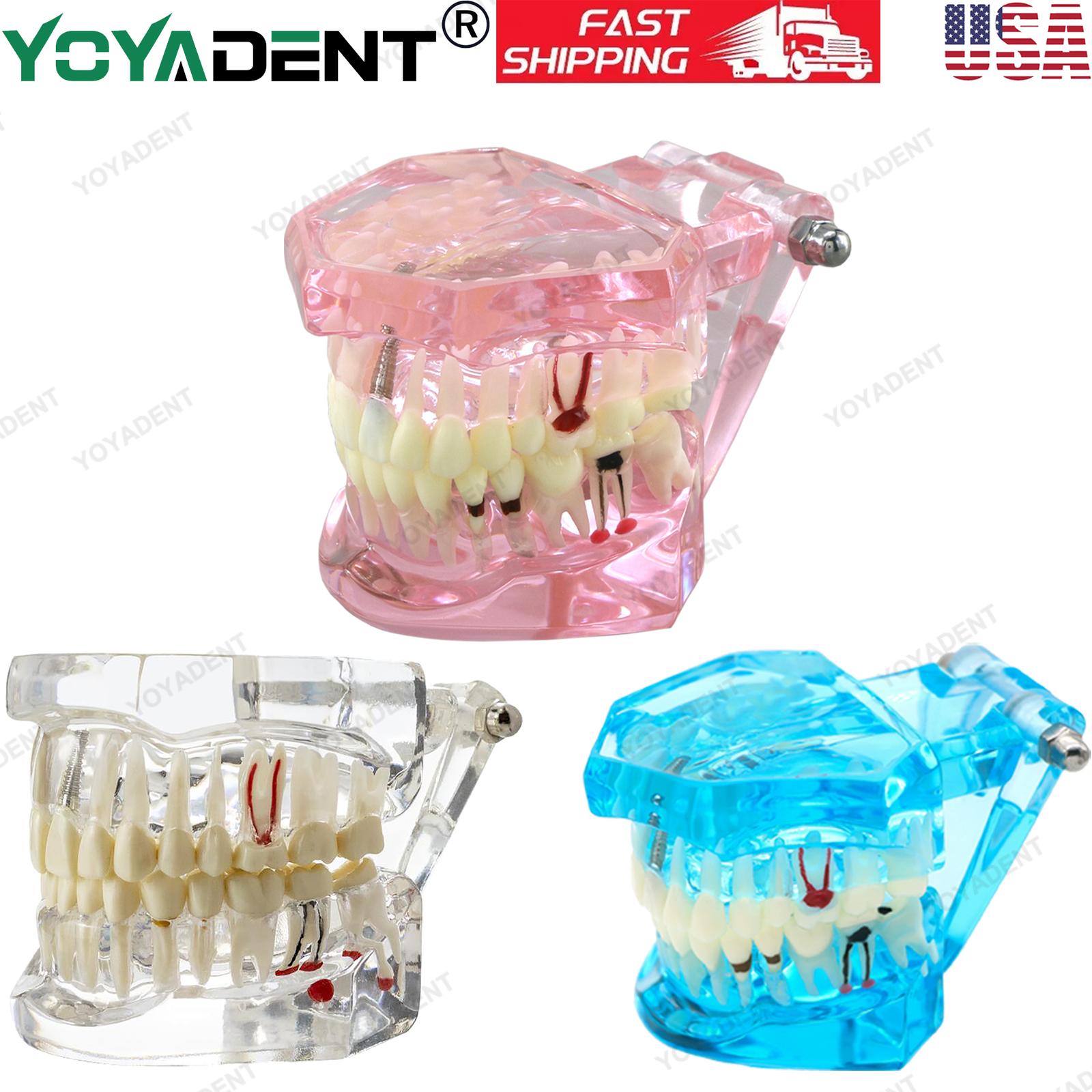 US Dental Typodont Teeth Model Implant Restoration Orthodontics Demo Teaching