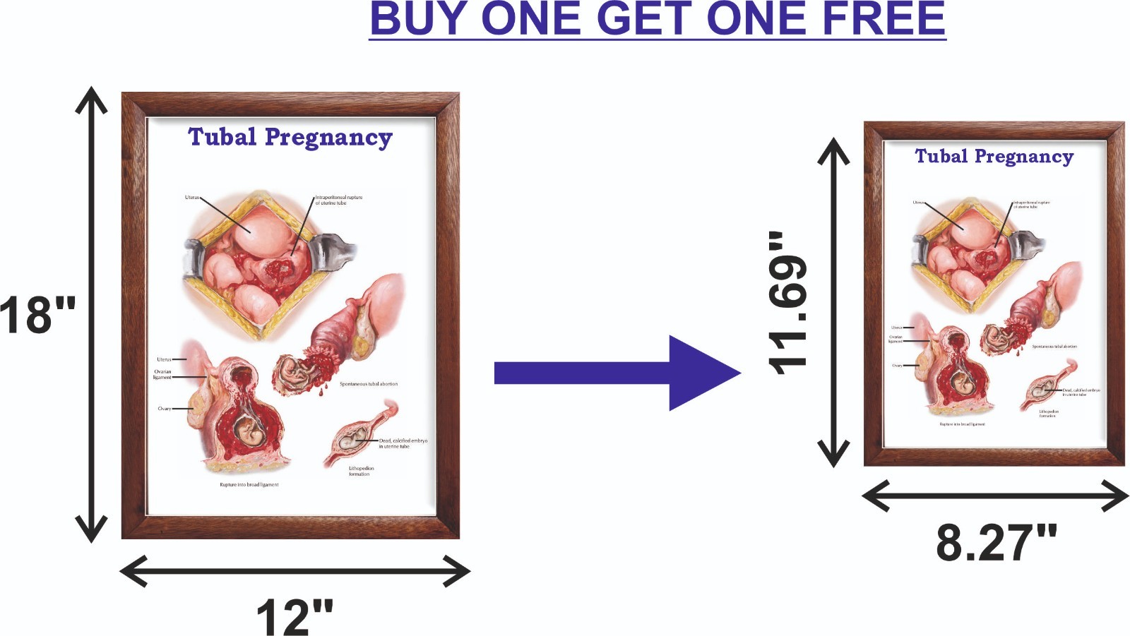 Tubal Pregnancy Chart 12×18 inches