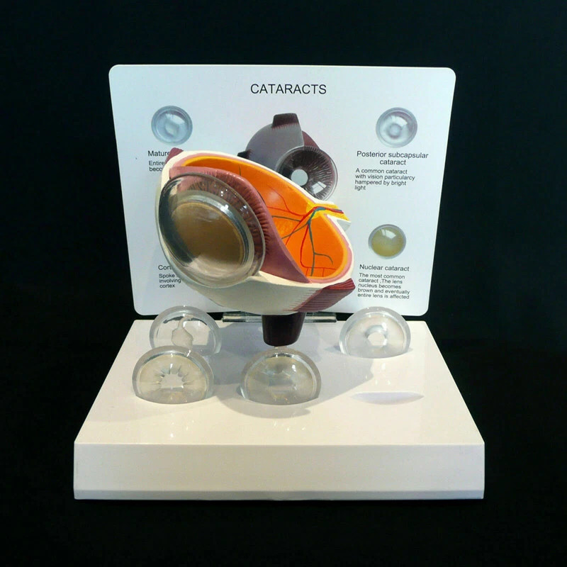 Anatomical Model of Human Cataract and Eye Disease-Medical Pathology Anatomy