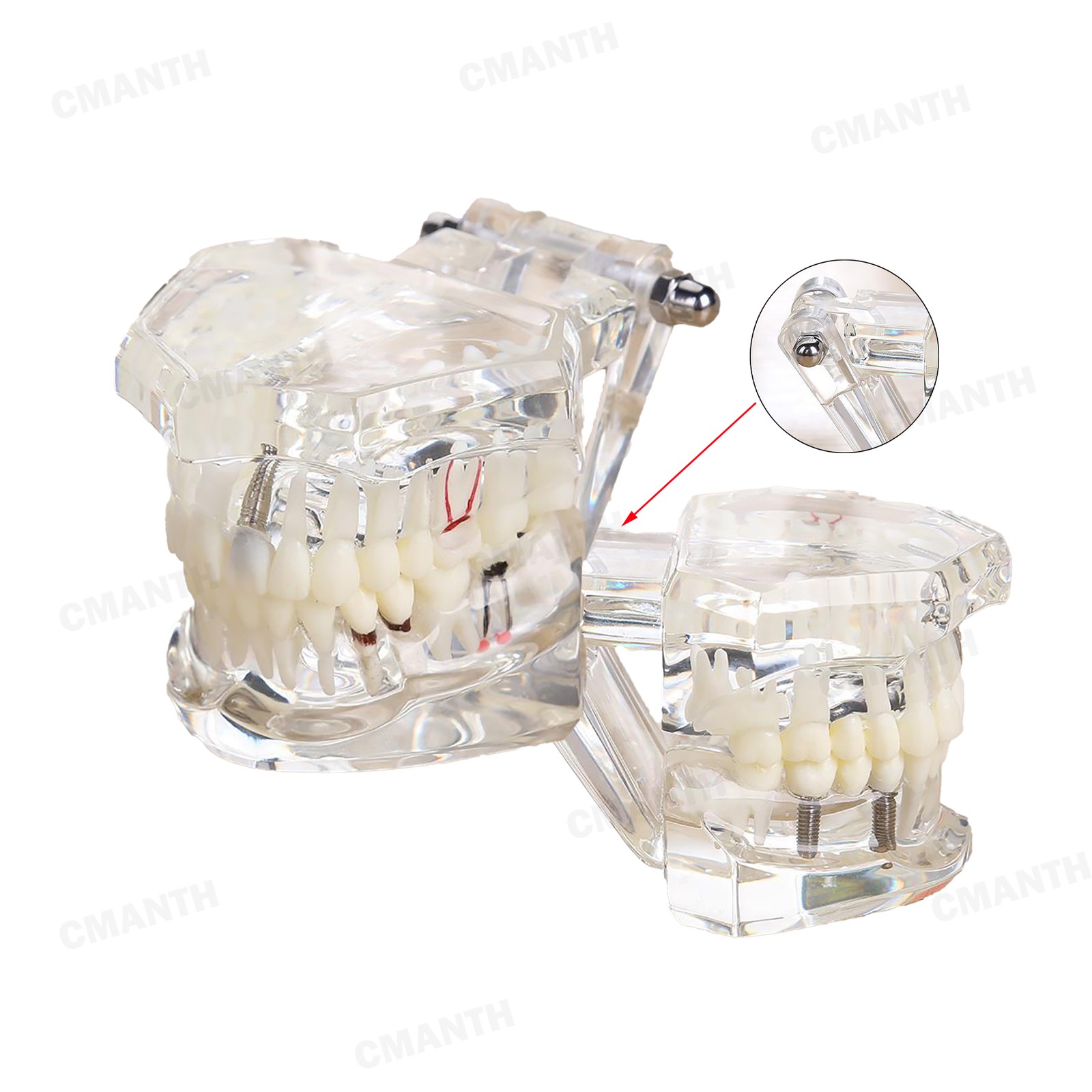 US Dental Teeth Implant Restoration Model Transparent Pathological Study Demo