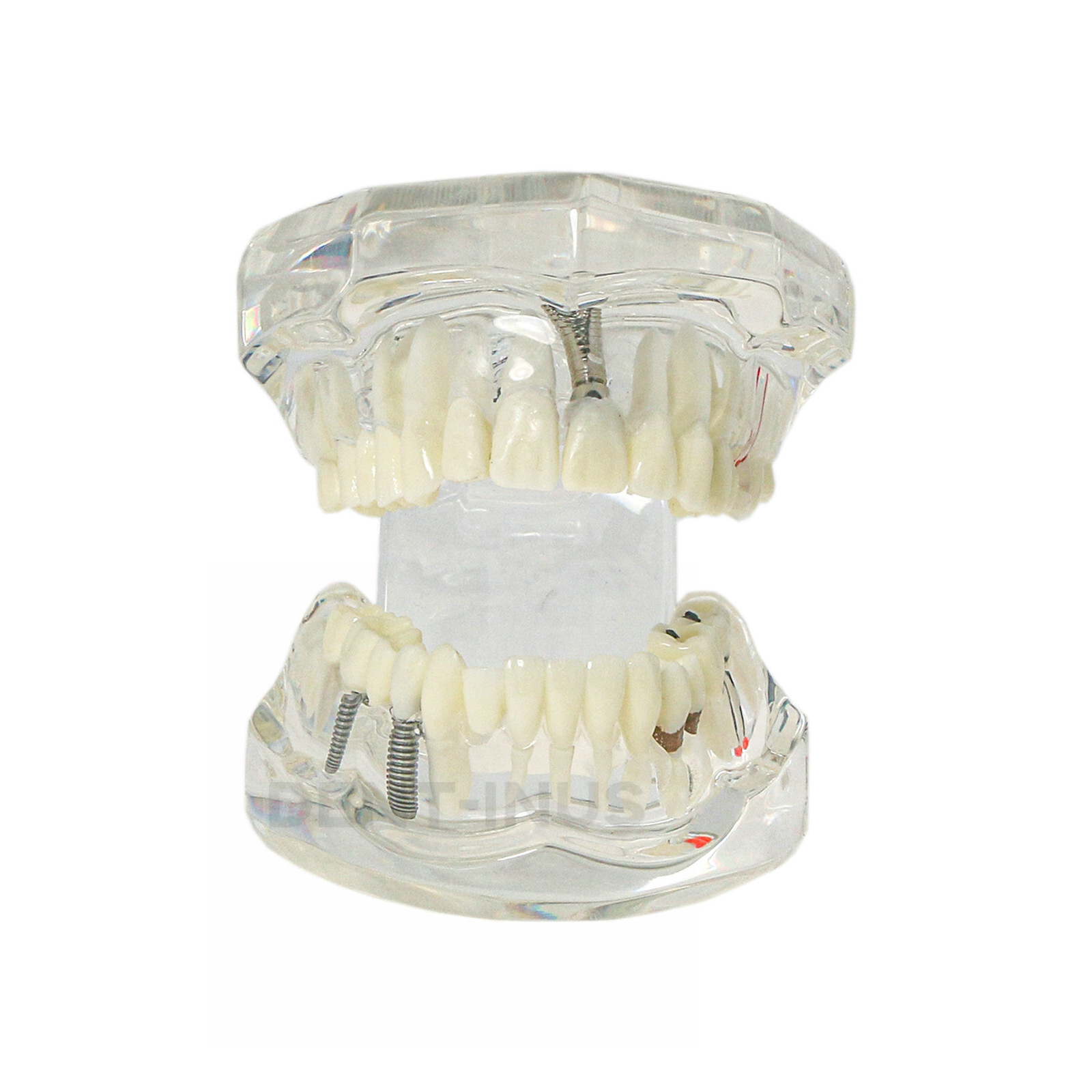 Multiple Types Dental Teeth Model Typodont Ortho Implant Practice Demo Teaching