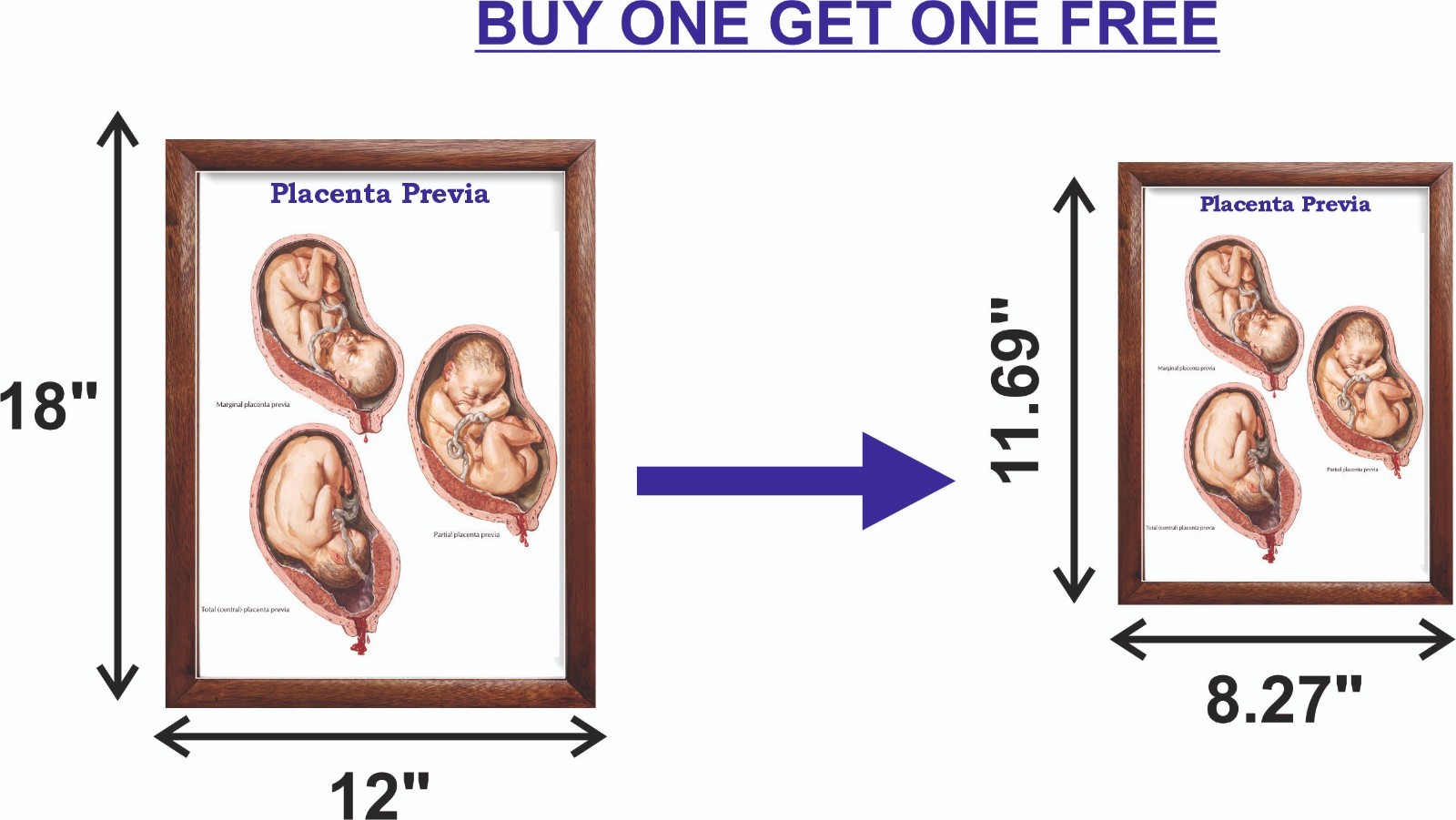 Placenta Previa Chart 12×18 inches