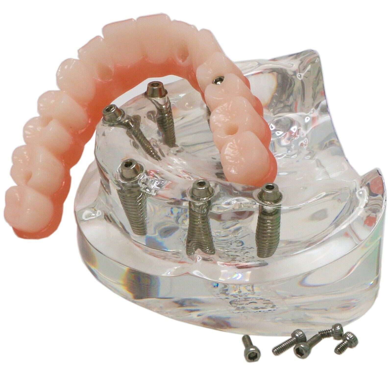 US Dental All-on-4/6 Screws Overdenture Implant Model Upper Jaw Restoration