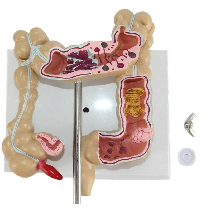 Anatomical Human Colon Intestine Pathological Diseases Model Medical Anatomy