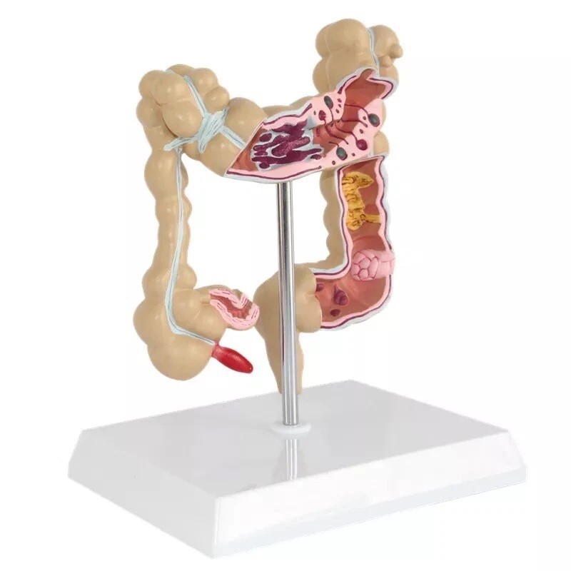 Anatomical Human Colon Intestine Pathological Diseases Model Medical Anatomy