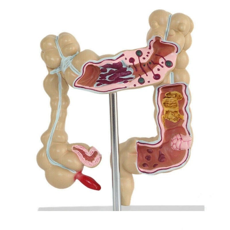 Anatomical Human Colon Intestine Pathological Diseases Model Medical Anatomy